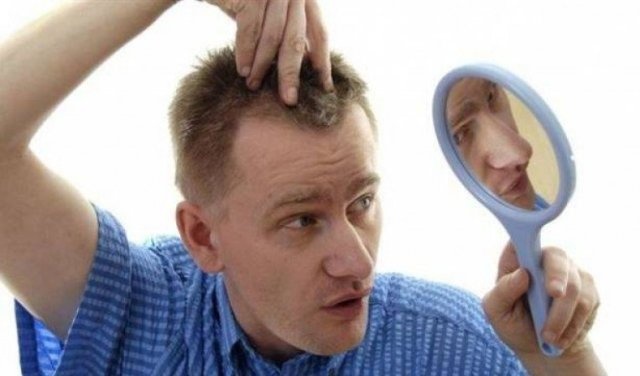 صفات الرجال المعرضين للصلع المبكر